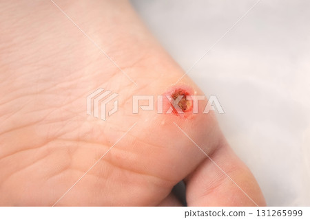 Wound of removed wart after laser removal on patient boy's foot, closeup view. 131265999
