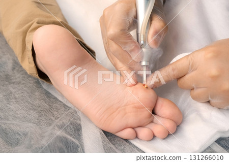 Surgeon removing wart on boy's foot using laser in hospital, hands closeup. Surgeon removing wart on boy's foot using laser in hospital, hands closeup. 131266010