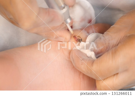 Surgeon removing wart on boy's foot using laser in hospital, hands closeup. 131266011