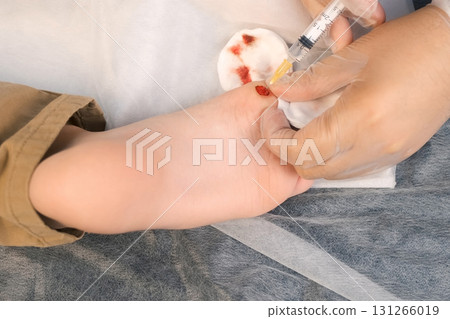 Surgeon gives injection of local anesthesia during laser removing wart on foot. Surgeon gives injection of local anesthesia during laser removing wart on foot. 131266019
