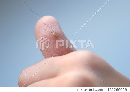 Big wart on human thumb finger before laser removing, closeup view. Big wart on human thumb finger before laser removing, closeup view. 131266029