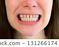 Mouth of young woman with yellow bad teeth preparing to install ceramic veneers. 131266174