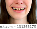 Mouth of young scary woman with yellow bad teeth smiling looking at camera. 131266175