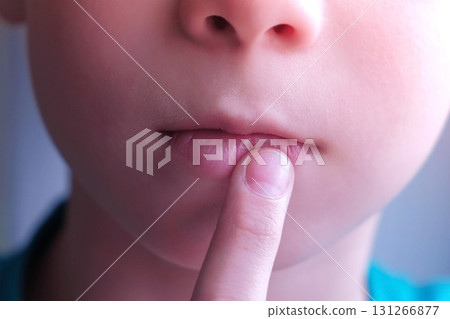 Child boy touches herpes sore on the lip, mouth closeup. 131266877