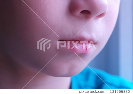 Child boy with cracked dry lip, mouth closeup. 131266880