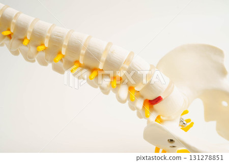 Spinal nerve and bone, Lumbar spine displaced herniated disc fragment, Model for treatment medical in the orthopedic department. 131278851