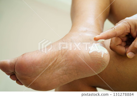 Asian woman check feet with crack and dry heel skin, Diabetic Foot. 131278884