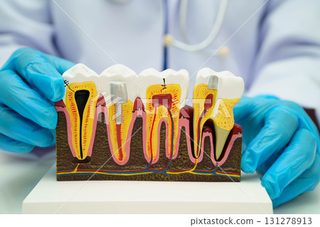 Dentist holding dental implant, artificial tooth roots into jaw, root canal of dental treatment, gum disease, teeth model for dentist. 131278913