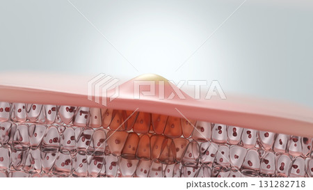 橫斷面圖示:化膿性黃色痤瘡和皮膚炎症 橫斷面圖示:化膿性黃色痤瘡和皮膚炎症 131282718