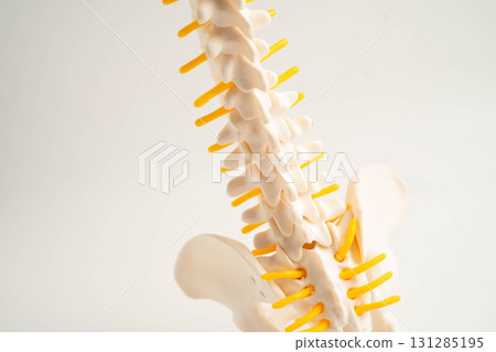 Spinal nerve and bone, Lumbar spine displaced herniated disc fragment, Model for treatment medical in the orthopedic department. 131285195