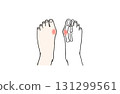 拇外翻患者雙腳發炎疼痛的插圖/一隻腳的 X 光片/插圖 131299561