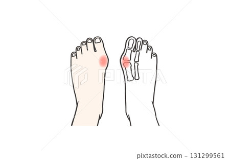 Illustration of both feet of a person with hallux valgus who is inflamed and in pain / X-ray of one foot / illustration Illustration of both feet of a person with hallux valgus who is inflamed and in pain / X-ray of one foot / illustration 131299561