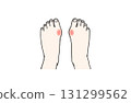 拇外翻患者雙腳發炎疼痛的圖示 131299562