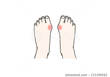 Illustration of both feet of a person with hallux valgus who is inflamed and in pain Illustration of both feet of a person with hallux valgus who is inflamed and in pain 131299562