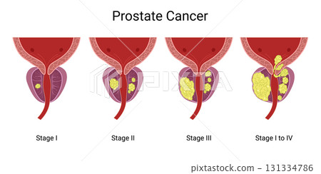 Prostate Cancer. Prostate Tumor. Normal Prostate and Enlarged Prostate Gland under Bladder. Normal prostate and prostate with cancer. Prostatitis is inflammation of the prostate gland. Male reproducti 131334786