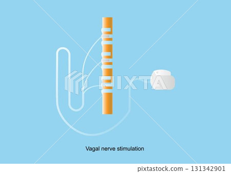 Vagal nerve stimulation (VNS). Neuromodulation device for treatment of epilepsy Vagal nerve stimulation (VNS). Neuromodulation device for treatment of epilepsy 131342901
