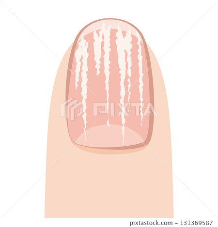 扁平苔指甲 131369587