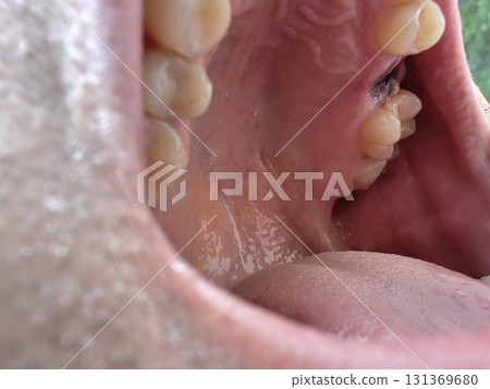 open mouth of a man with the place of pulled out small molar tooth, healing of a wound in the place of the tooth. 131369680