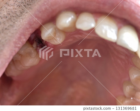open mouth of a man with the place of pulled out small molar tooth, healing of a wound in the place of the tooth. 131369681