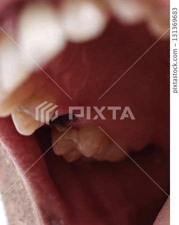 open mouth of a man with the place of pulled out small molar tooth, healing of a wound in the place of the tooth. open mouth of a man with the place of pulled out small molar tooth, healing of a wound in the place of the tooth. 131369683