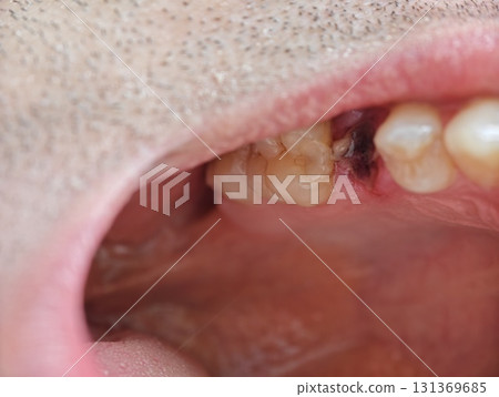 open mouth of a man with the place of pulled out small molar tooth, healing of a wound in the place of the tooth. open mouth of a man with the place of pulled out small molar tooth, healing of a wound in the place of the tooth. 131369685