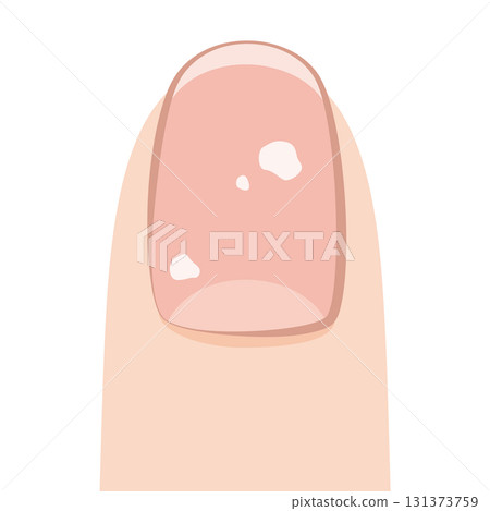 指甲有白點 131373759