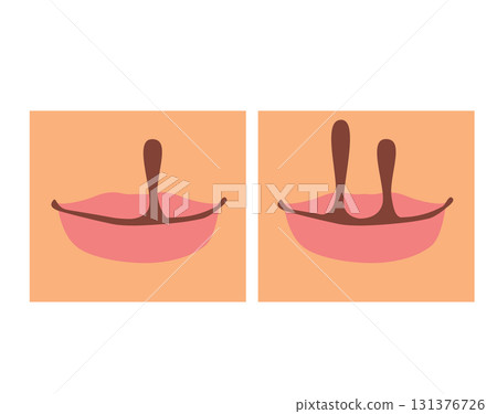 Cartoon Illustration Of Cleft Lip And Palate Infographic On Skin Background 131376726
