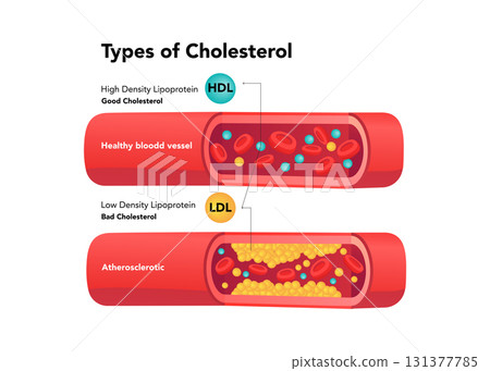 Types of cholesterol comparison with HDL and LDL stock illustration Types of cholesterol comparison with HDL and LDL stock illustration 131377785