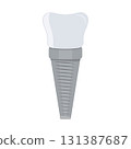 Dental implant. Screw prosthesis, Illustration of dental implantation,orthodontic dental implantation 131387687