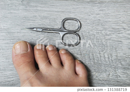 diseases of the nails, skin on the feet. Treatment at home 131388719