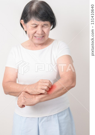 Elderly woman itching arm and body scratching for Skin Allergy from insect bite and food dermatitis. Dermatology, Leprosy day, Systemic lupus erythematosus, Psoriasis, Urticaria and rash Eczema 131410640