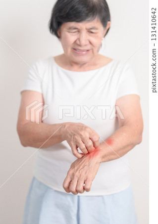 Elderly woman itching arm and body scratching for Skin Allergy from insect bite and food dermatitis. Dermatology, Leprosy day, Systemic lupus erythematosus, Psoriasis, Urticaria and rash Eczema Elderly woman itching arm and body scratching for Skin Allergy from insect bite and food dermatitis. Dermatology, Leprosy day, Systemic lupus erythematosus, Psoriasis, Urticaria and rash Eczema 131410642