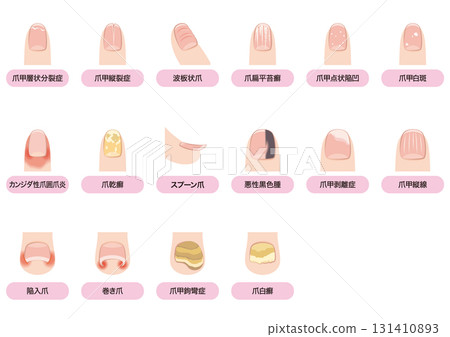 指甲疾病列表 131410893