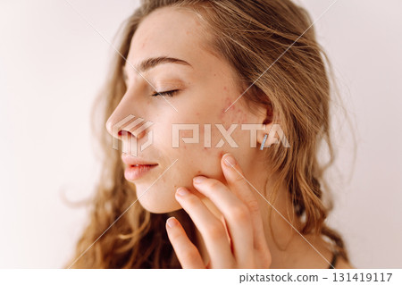 Portrait of a beautiful young woman with inflammations on the skin of her face. Acne disease. 131419117