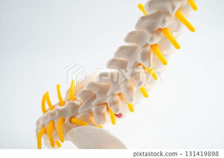 Lumbar spine displaced herniated disc fragment, spinal nerve and bone. Model for treatment medical in the orthopedic department. Lumbar spine displaced herniated disc fragment, spinal nerve and bone. Model for treatment medical in the orthopedic department. 131419898