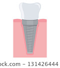 Dental implant. Screw prosthesis, Illustration of dental implantation,orthodontic dental implantation 131426444