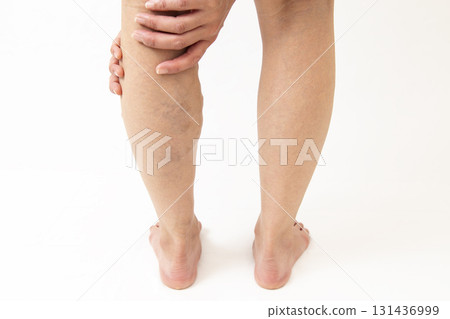 腿部靜脈曲張 131436999