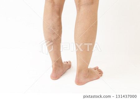 Varicose veins in legs Varicose veins in legs 131437000