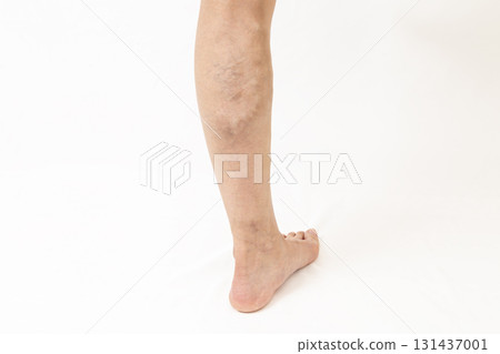 腿部靜脈曲張 131437001