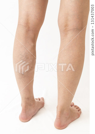 Varicose veins in legs 131437003