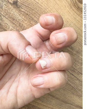 hand with damaged nail separates from flesh 131452910