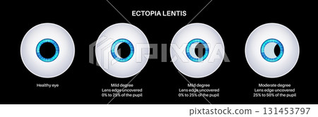 Ectopia lentis disease 131453797