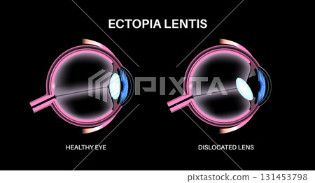 Ectopia lentis disease 131453798