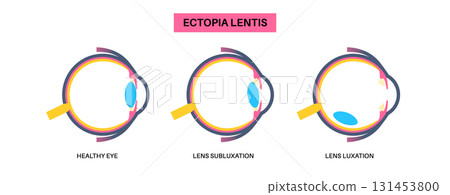 Ectopia lentis disease Ectopia lentis disease 131453800
