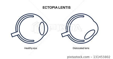 Ectopia lentis disease Ectopia lentis disease 131453802