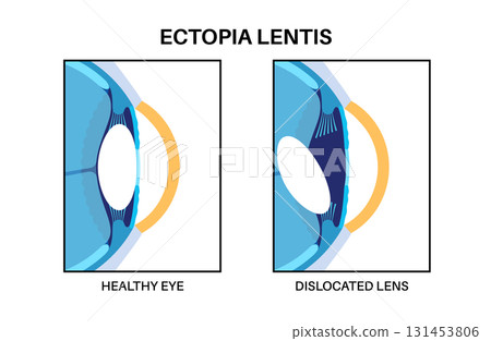 Ectopia lentis disease Ectopia lentis disease 131453806