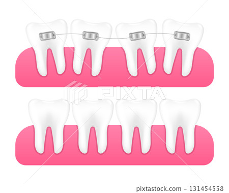 Braces on teeth. Alignment of teeth and bite correction with the help of braces system. Orthodontics braces. Dental care concept. Vector illustration. Braces on teeth. Alignment of teeth and bite correction with the help of braces system. Orthodontics braces. Dental care concept. Vector illustration. 131454558
