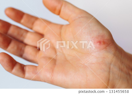 herpes on palm woman's hand 131455658