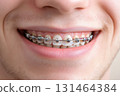 Close-up of man's smile with metal braces 131464384