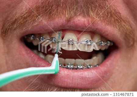 Adult man brushes his teeth with braces by interdental brush Adult man brushes his teeth with braces by interdental brush 131467871